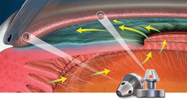 Glaukos, I-Stent Inject - Trattamento del glaucoma - immagine 2