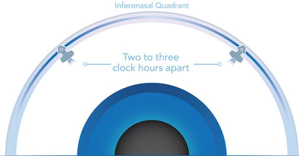 Glaukos, I-Stent Inject - Trattamento del glaucoma - immagine 3